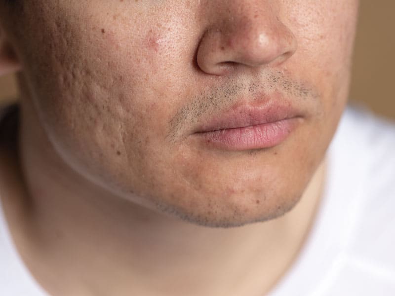 closeup da parte inferior do rosto de um homem com acne