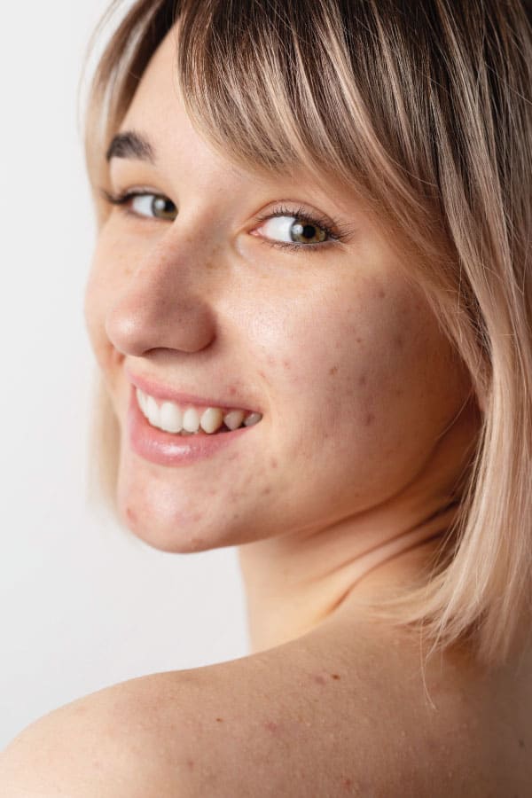 close up de mulher loura bonita e sorridente de perfil e com manchas de acne no rosto